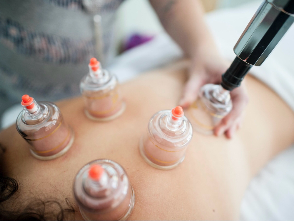 Cupping