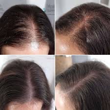 Scalp Pigmentation Female