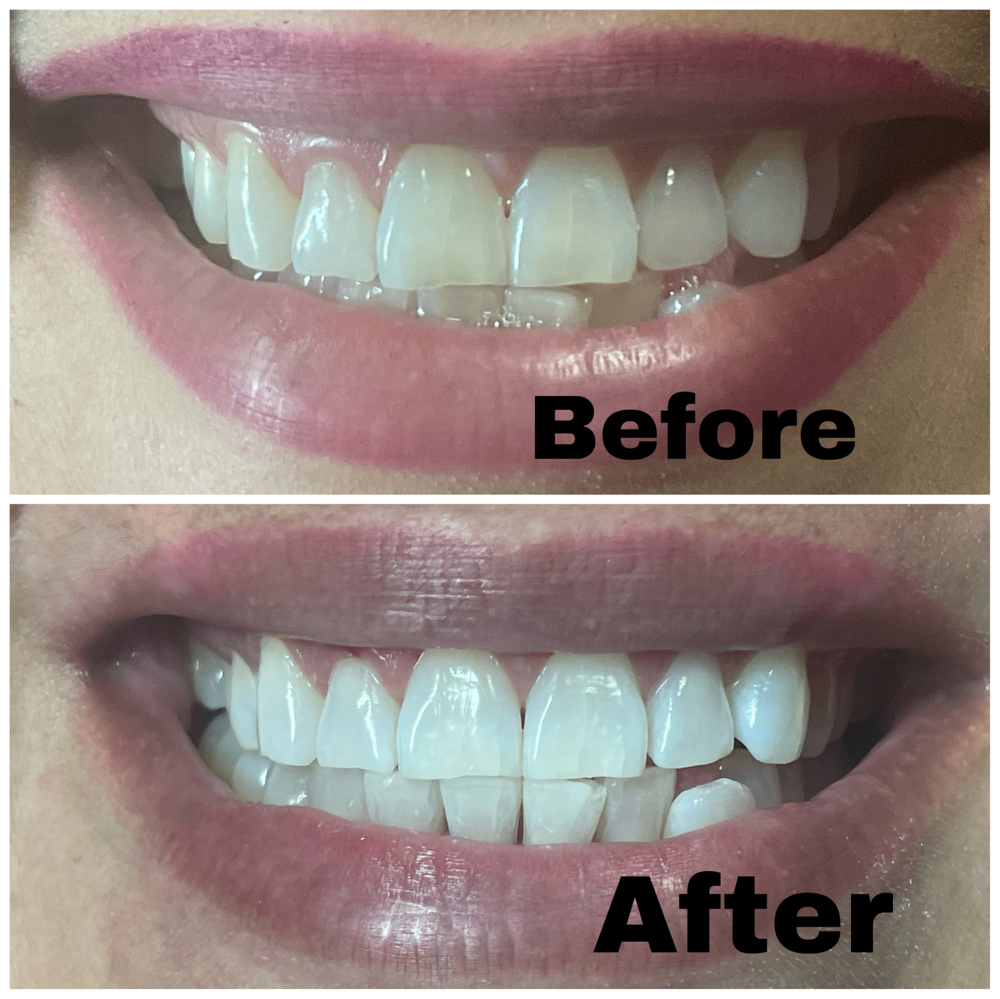 Teeth Whitening