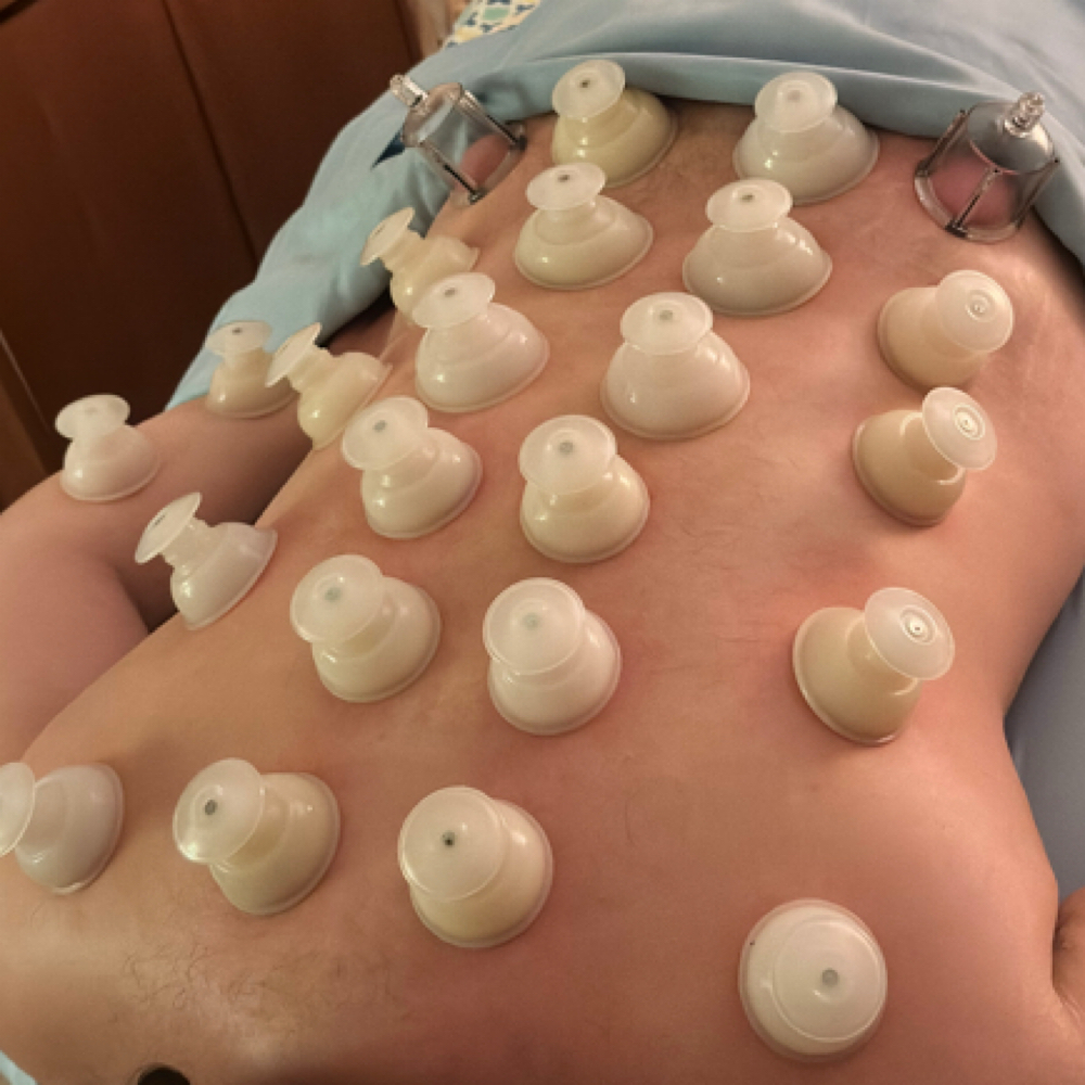 Cupping Enhancement at It is Wellness Holistic Health in Stratford, CT