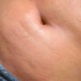 Belly Strip at Inclusive Esthetixs in CA, CA