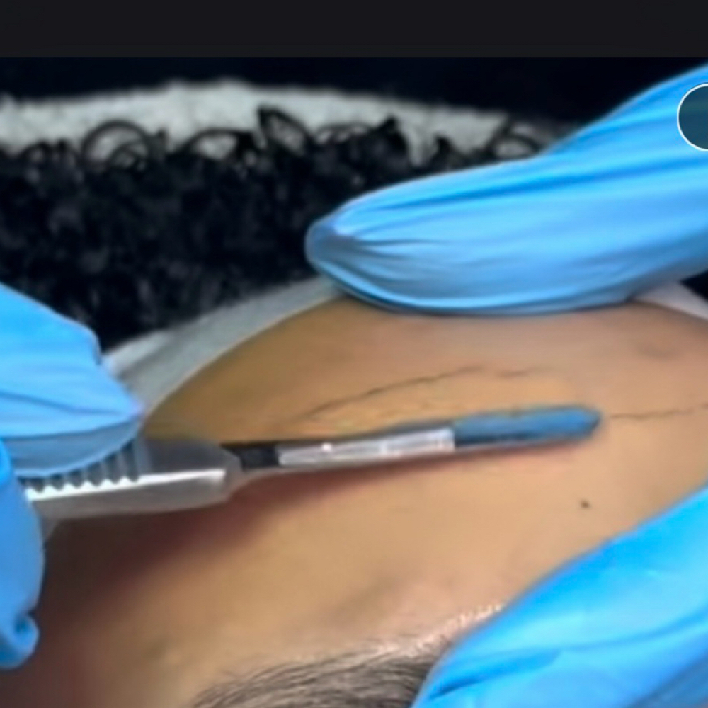 Dermaplaning Facial at Sweet Dreams Spa in Bronx, NY