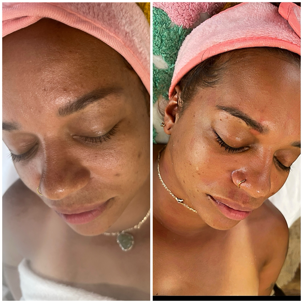 Custom Facial ( Face,Neck & Chest)