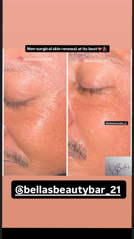 Facial Skin Tighthening