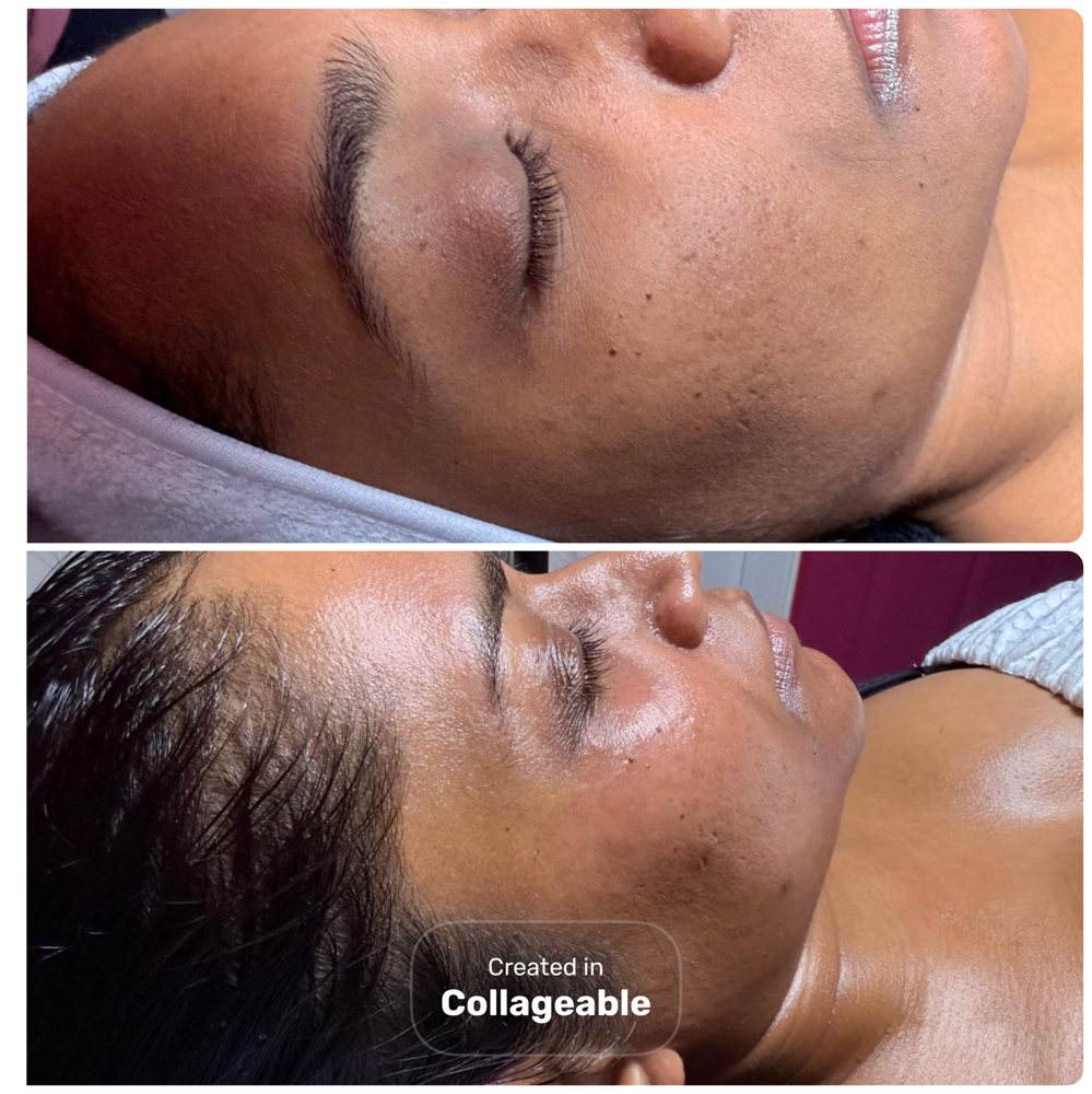Dermaplaning Add-On