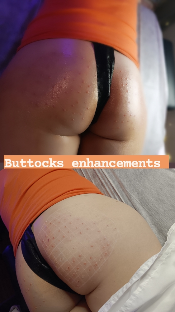 5ml  HA Buttocks Injections