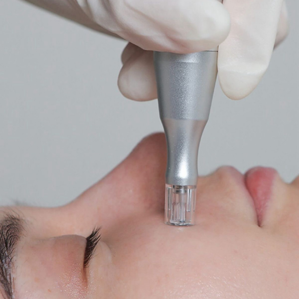 Customized Mirconeedling at BeyondTheFace in Charlotte, NC