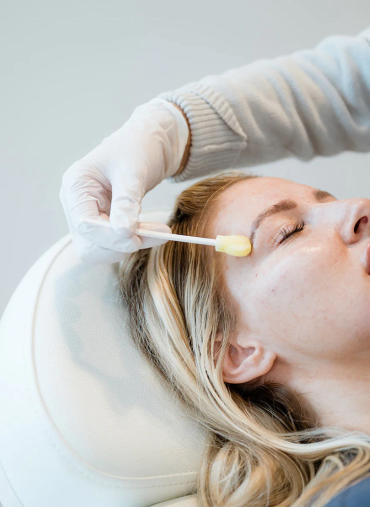Chemical Peel