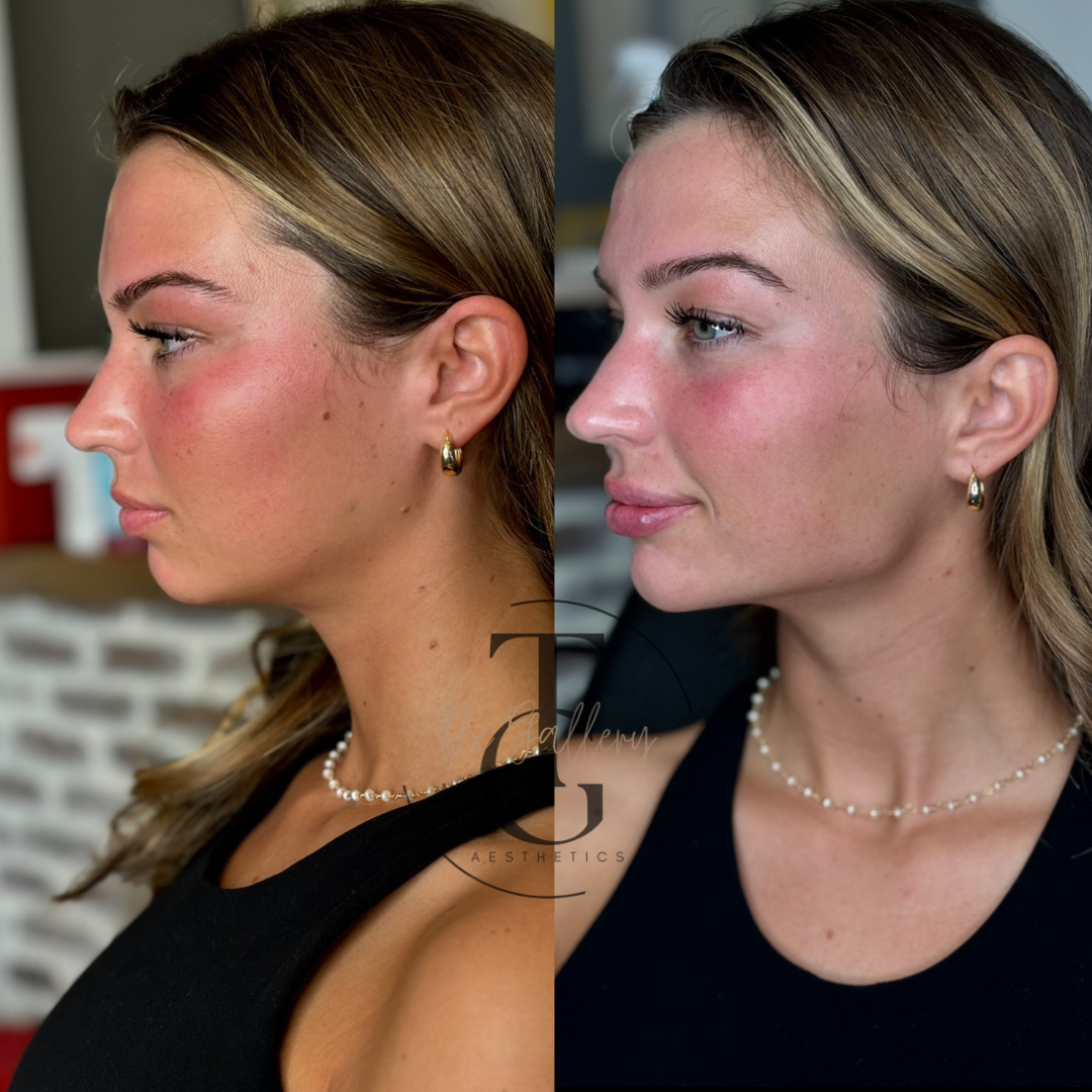 JAWLINE CONTOURING