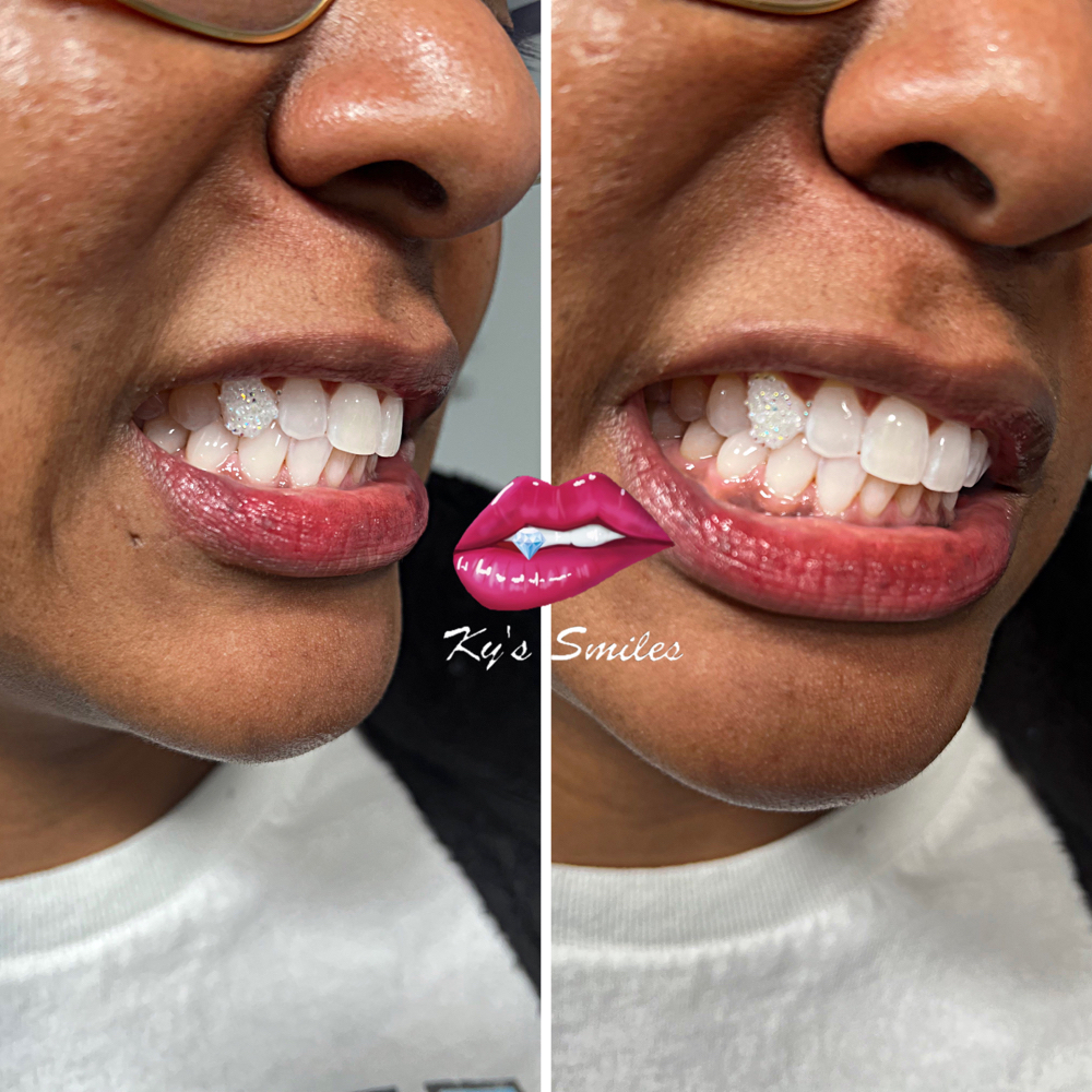 Chandiler Tooth ( Full Tooth )
