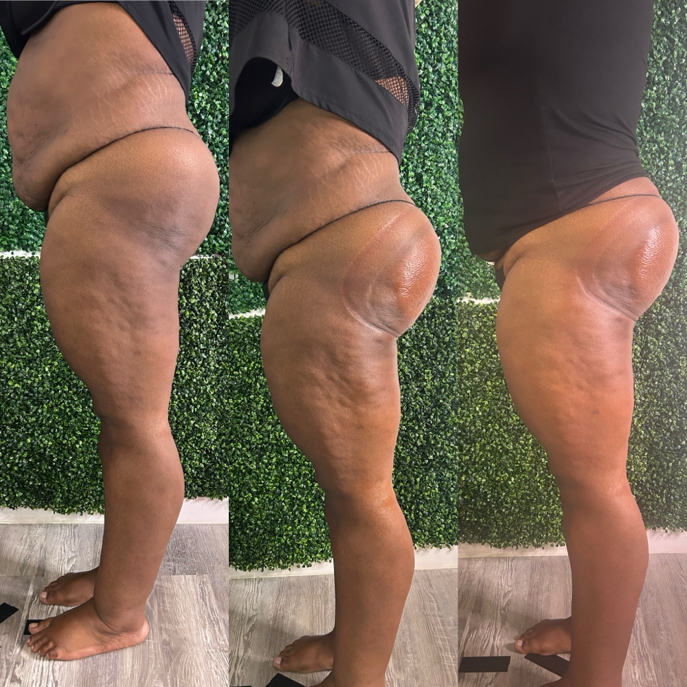 Vacuum Butt Therapy ( Give Me That) at HVS BODY in Shaker Hts, OH