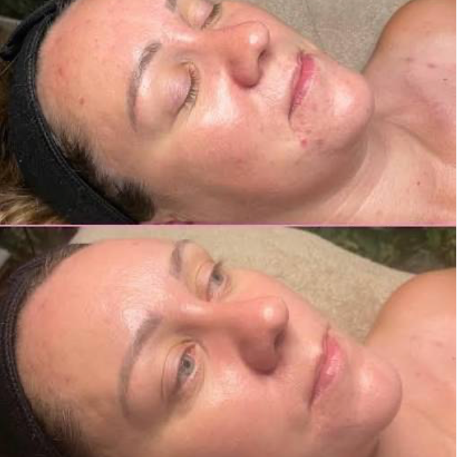 Pure Peel at Fitzskin in Gilbert, AZ