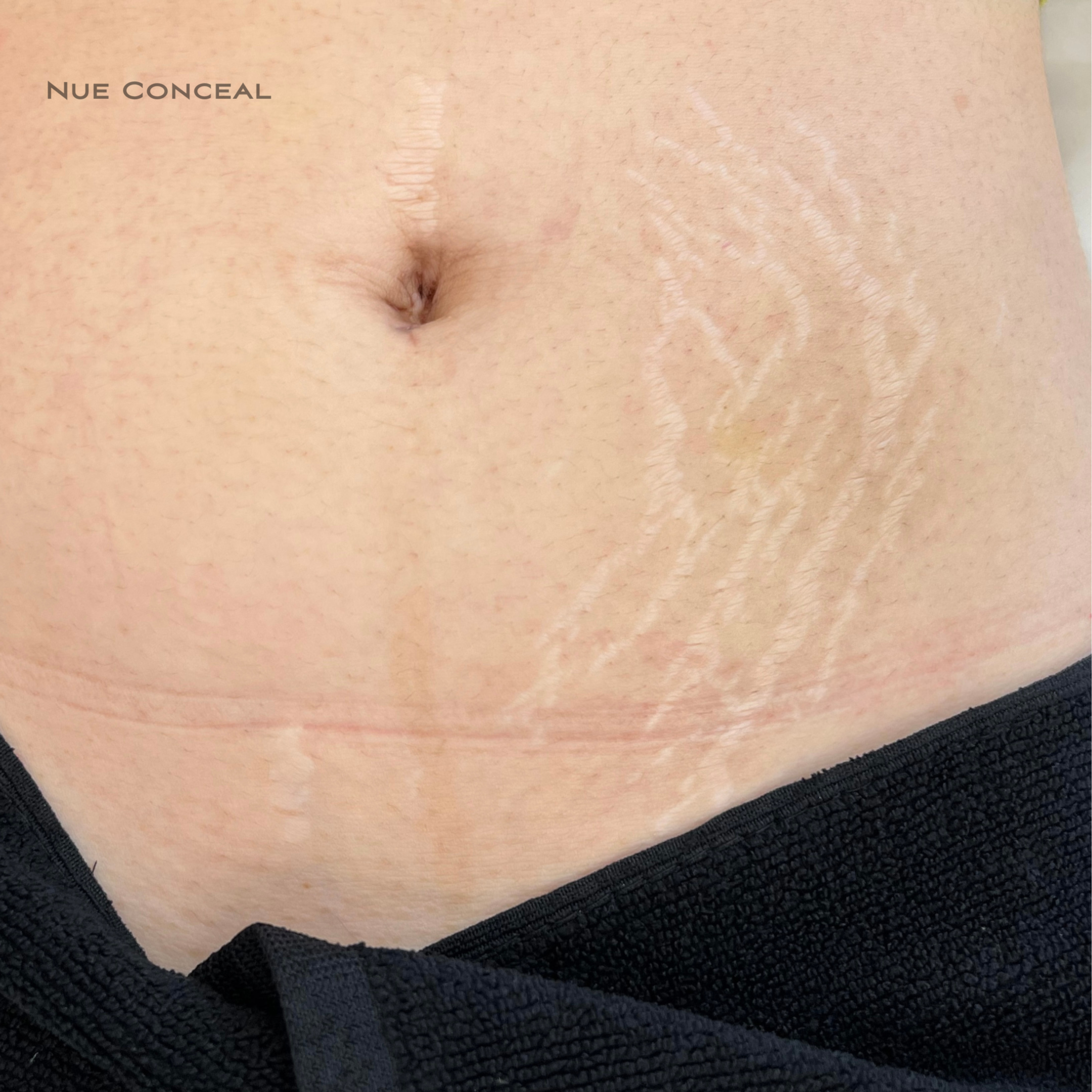 Stretch Mark Inkless or Camouflage at Pamper Me Ink  Paramedical Tattooing in Tucson, AZ