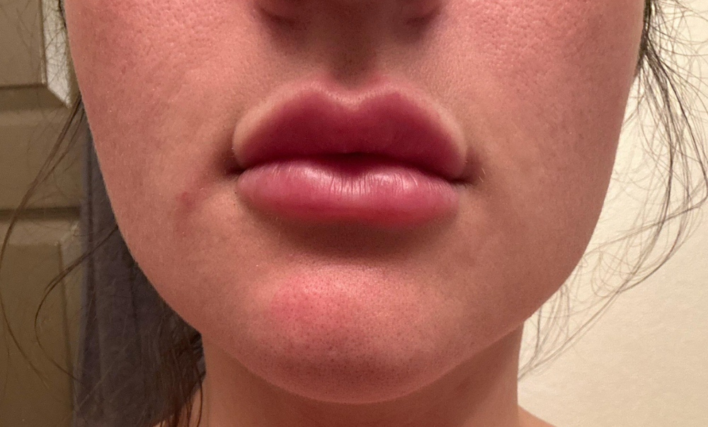 Dermal Filler Dissolver