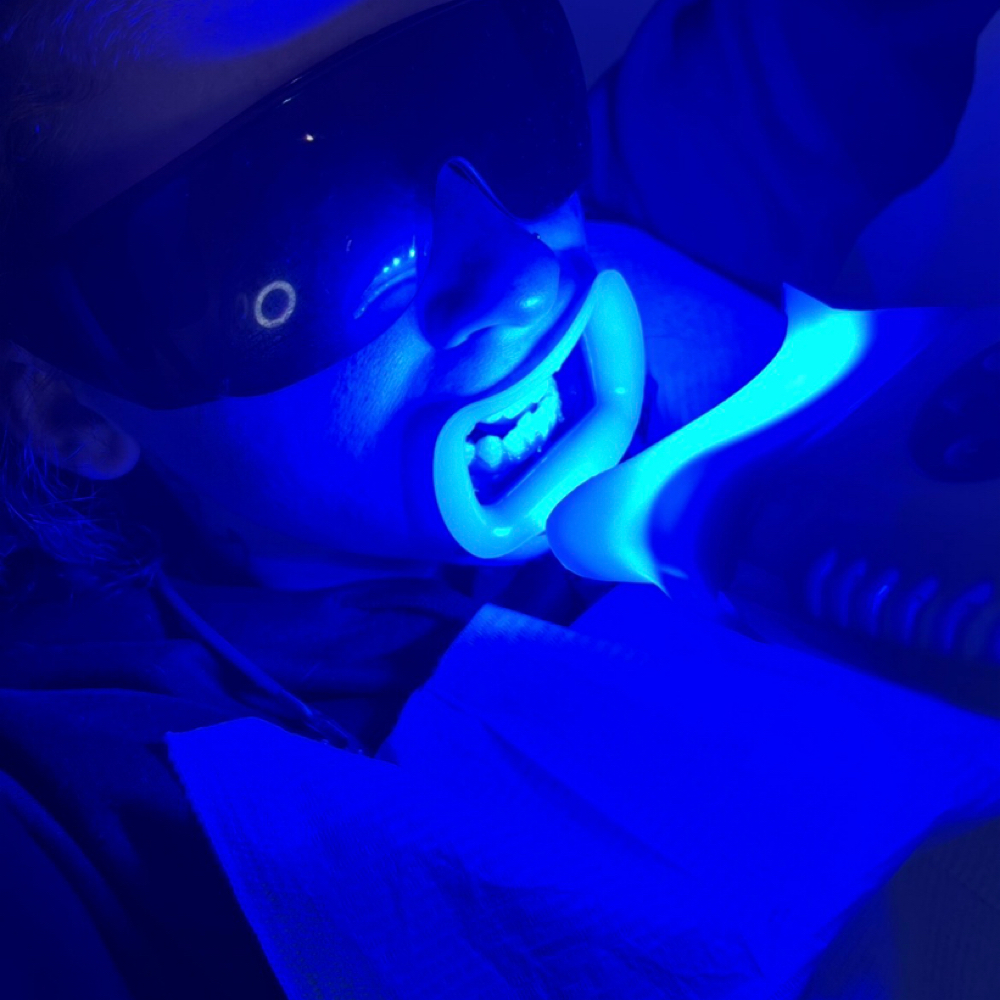 Retouch-  20 Minute Whitening at Envious Smiles & Beauty in Rockford, IL