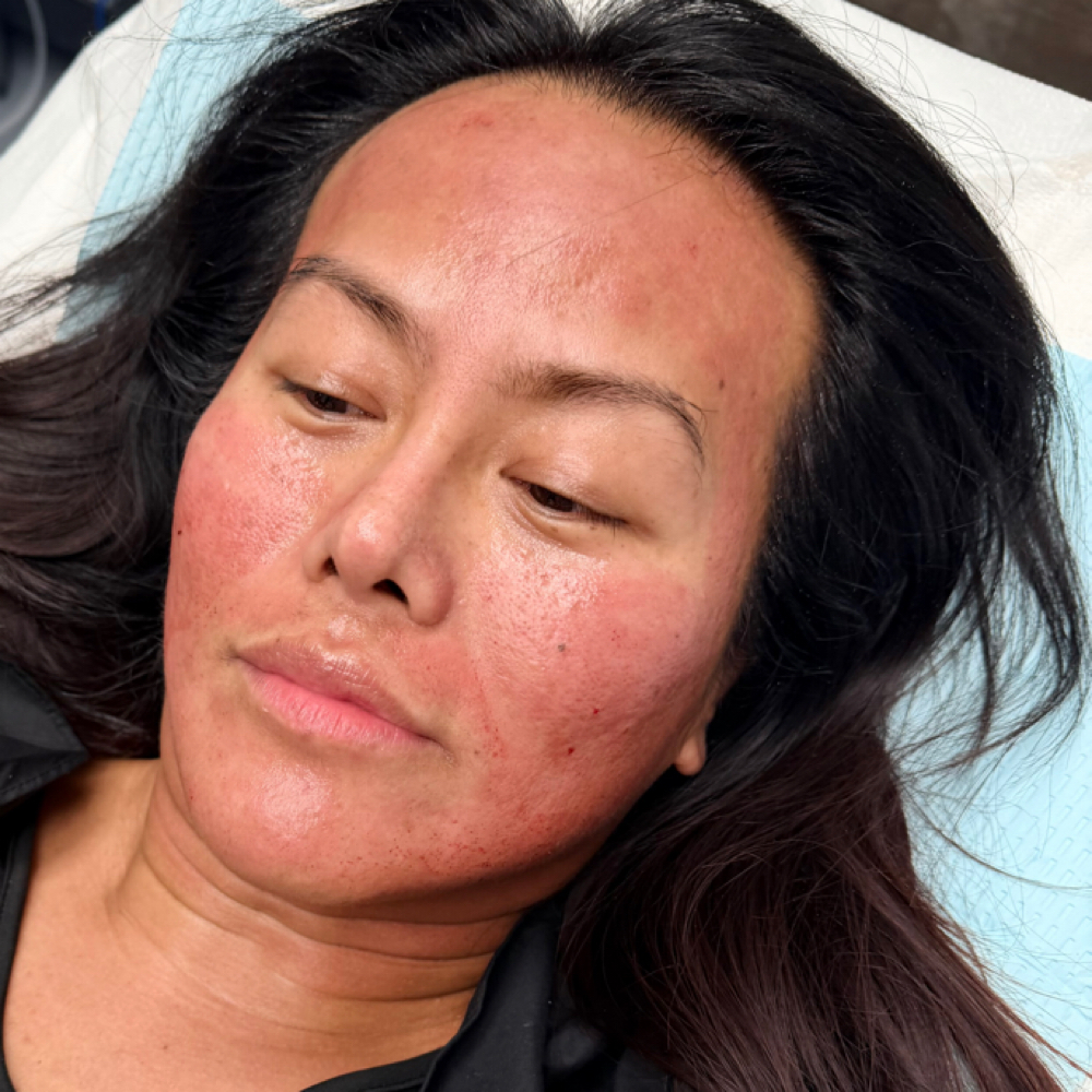 SkinStylus™ Micro/Nanoneedling at Unmasked Aesthetics in Vancouver, WA