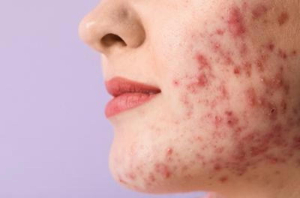 Virtual Acne Bootcamp at Rosiane Delicoli Skincare in Lafaytte, CA