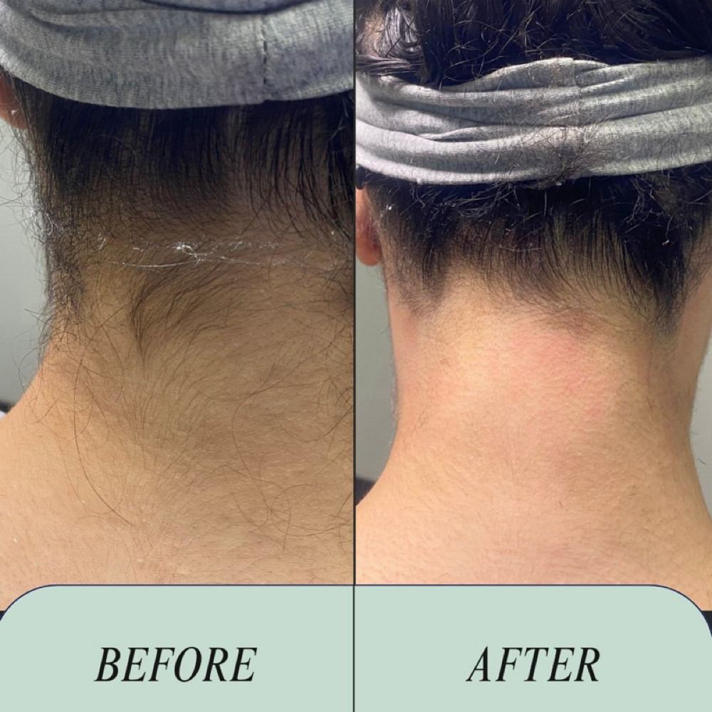 Nape/Laser Hair Removal at Gigi’s Beauté LLC in Lanham, MD