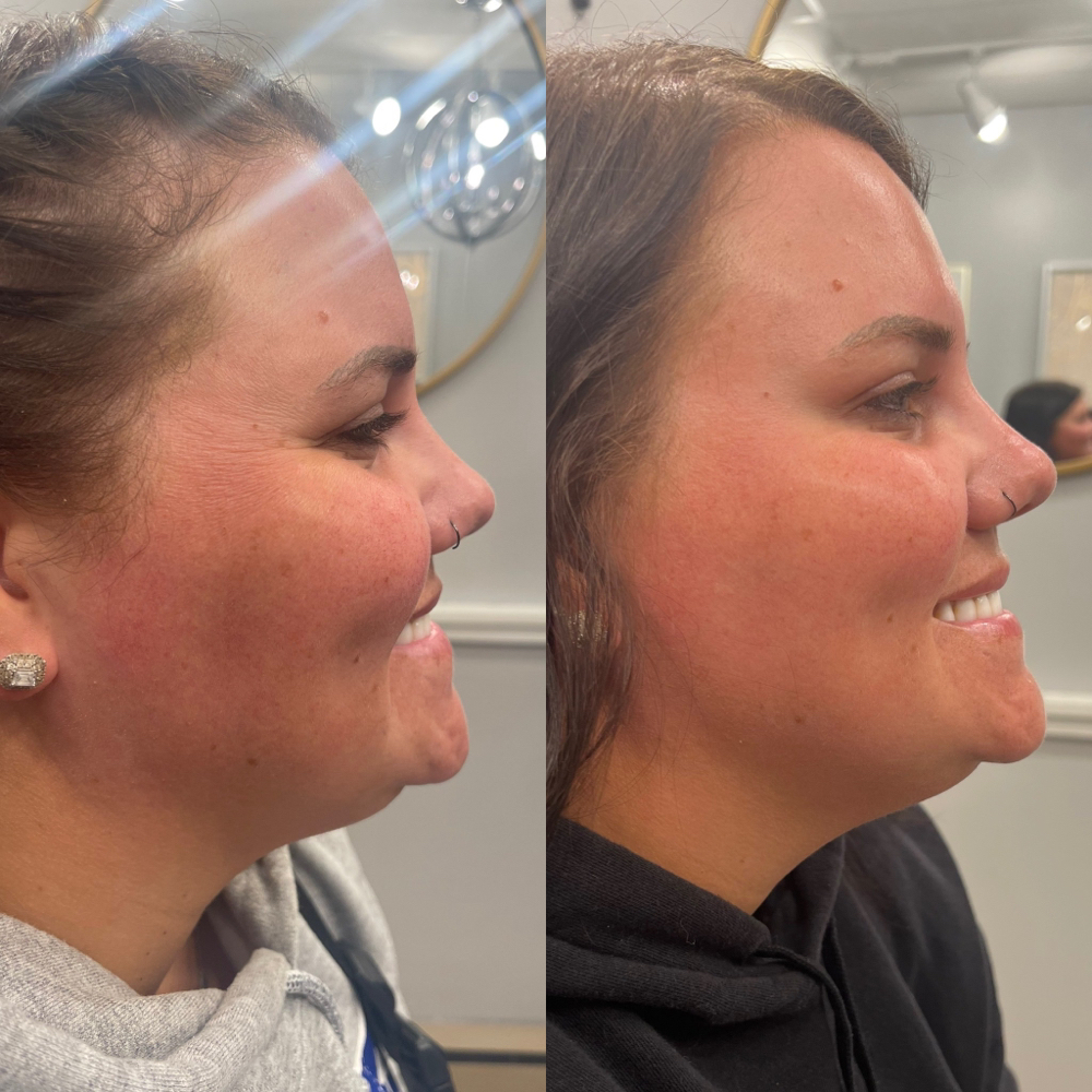 Facial Slimming