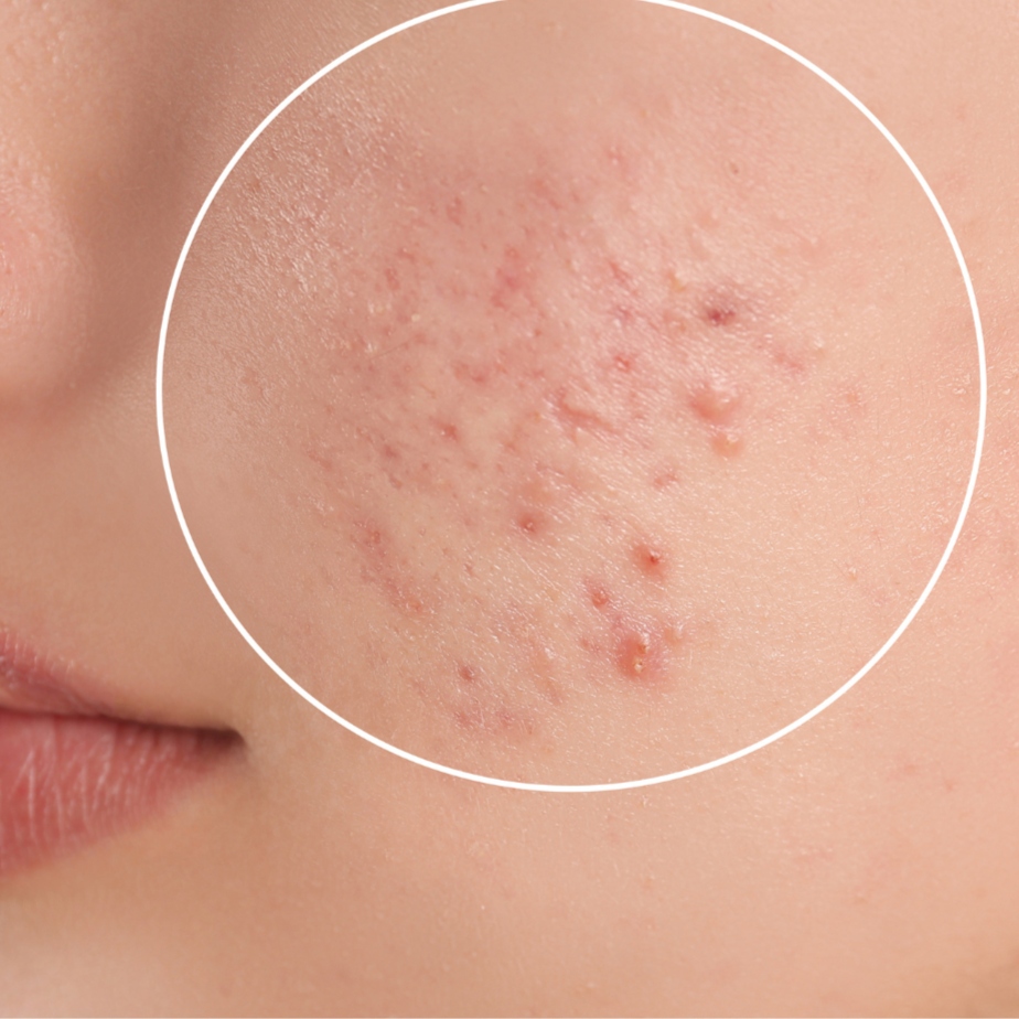Acne Facial at AKS Salon and Day Spa in Mechanicsburg, PA