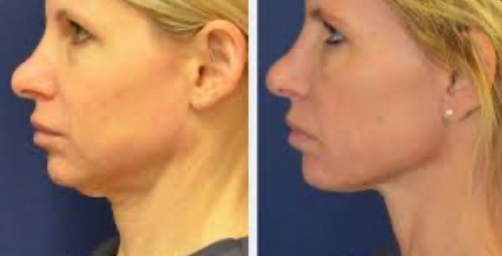 💖Non Sugical Facelift & Chin Lift