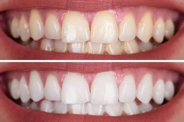 Teeth Whitening at Lavishly Lashing in Bangor, ME