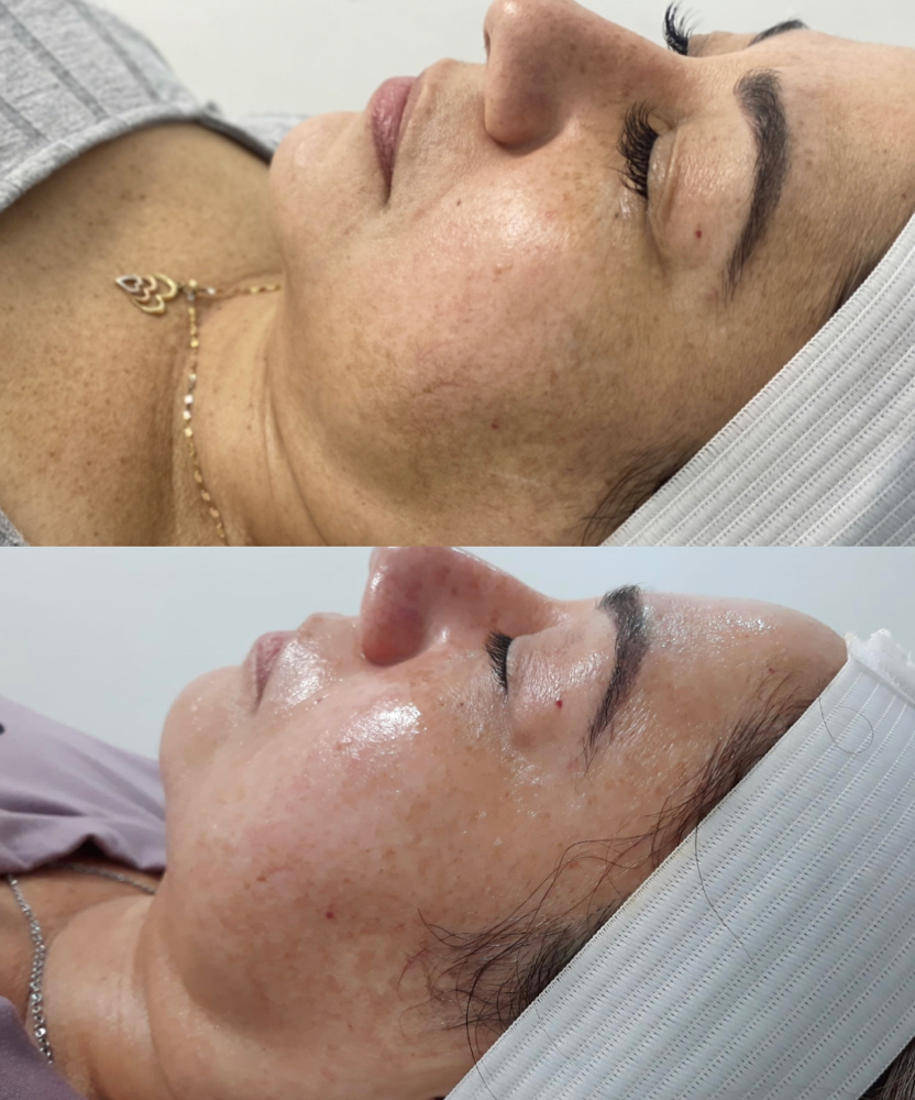 Facial Ice Botox y Plasma Ozono at PRIVÉ in Carolina, PR