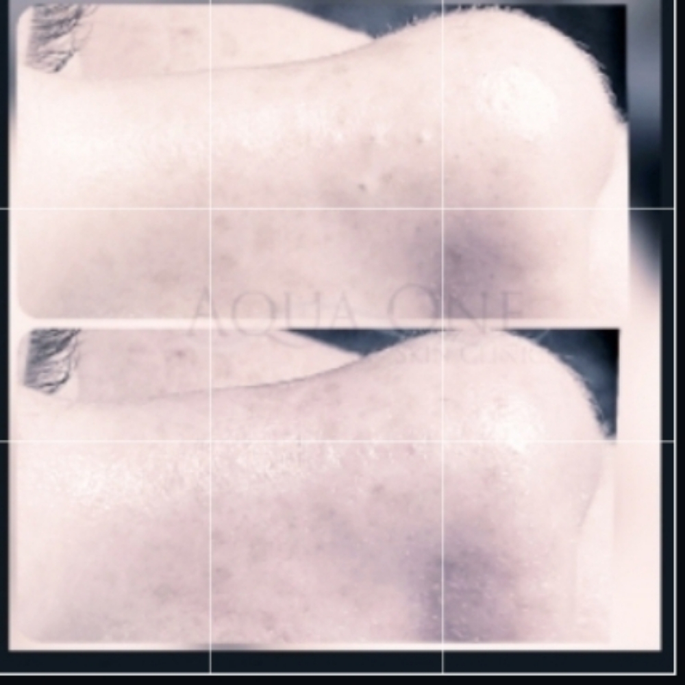 Signature Acne Facial Adult/Youth at Aqua One Skin Clinic in Jasper, IN