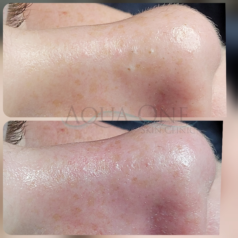 Teen/Youth Acne Treatment