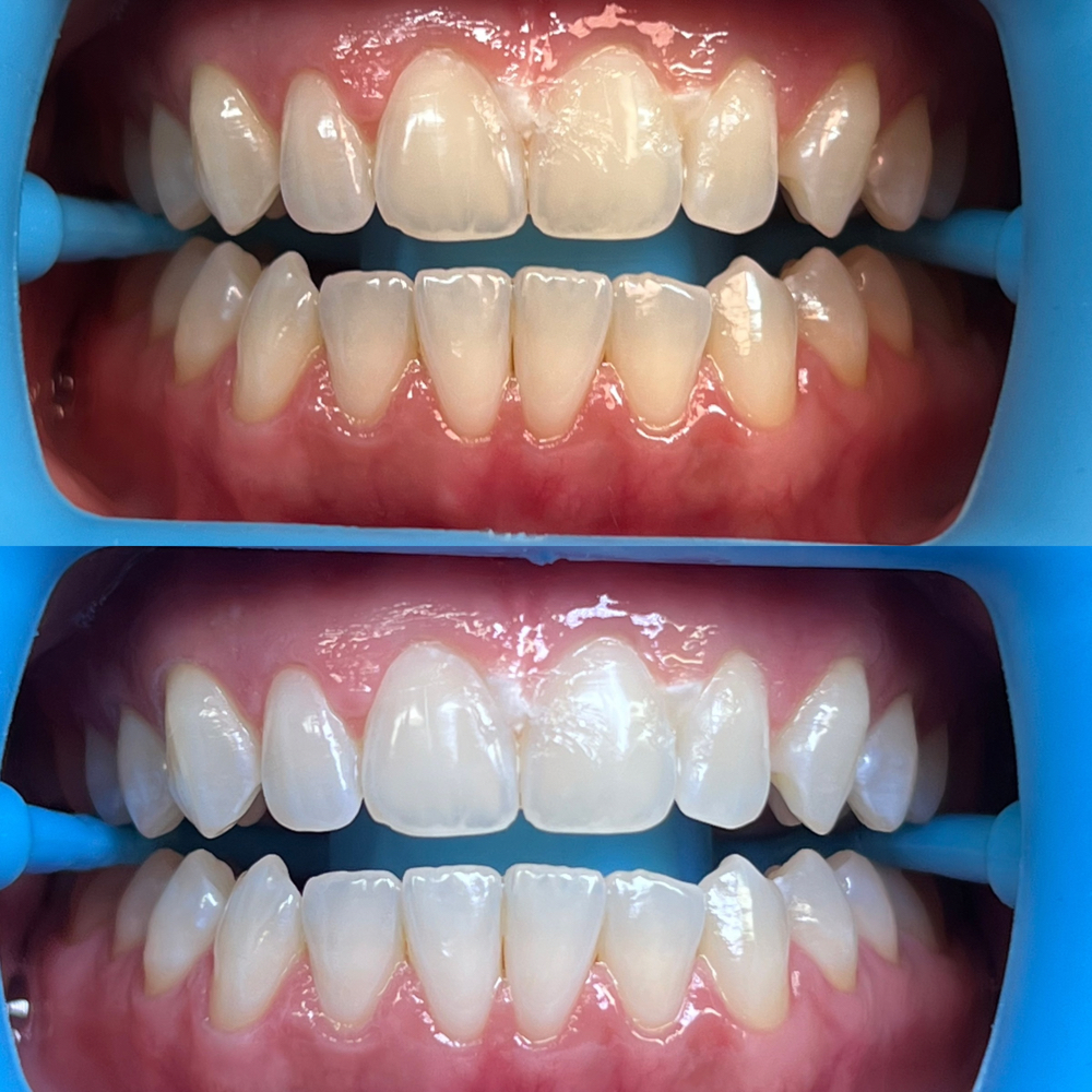 Teeth Whitening at Blessed Beauty Aesthetics, LLC in Houston, TX