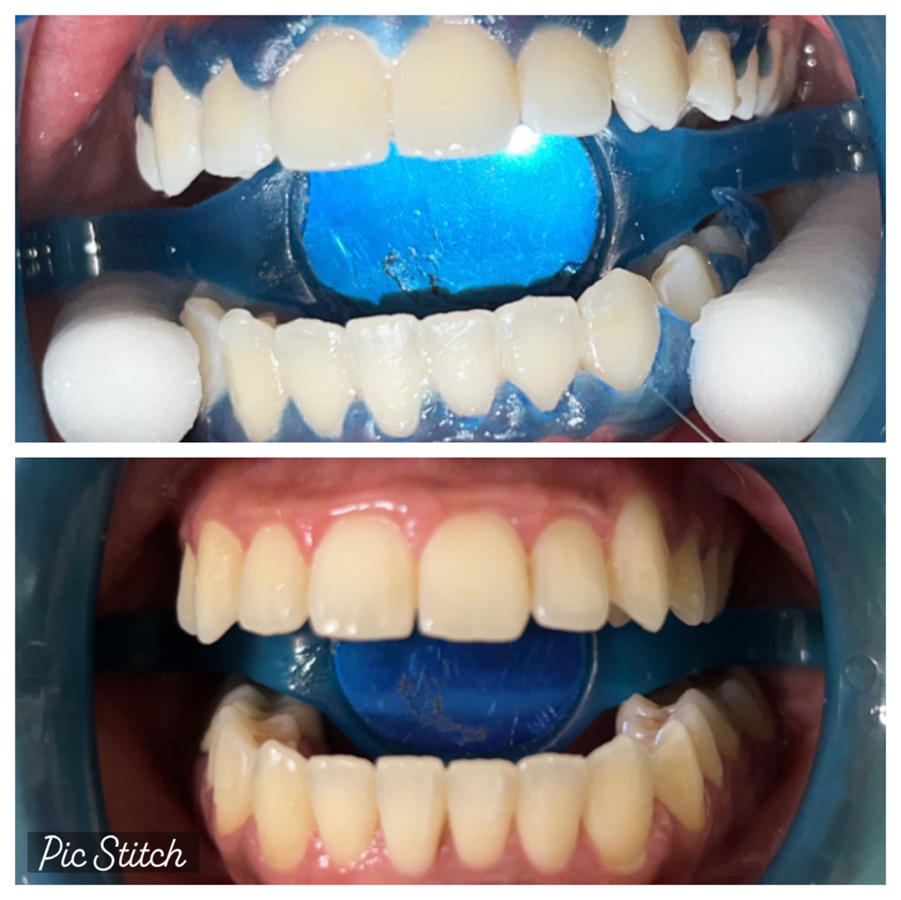 Hollywood smile (Most Popular)
