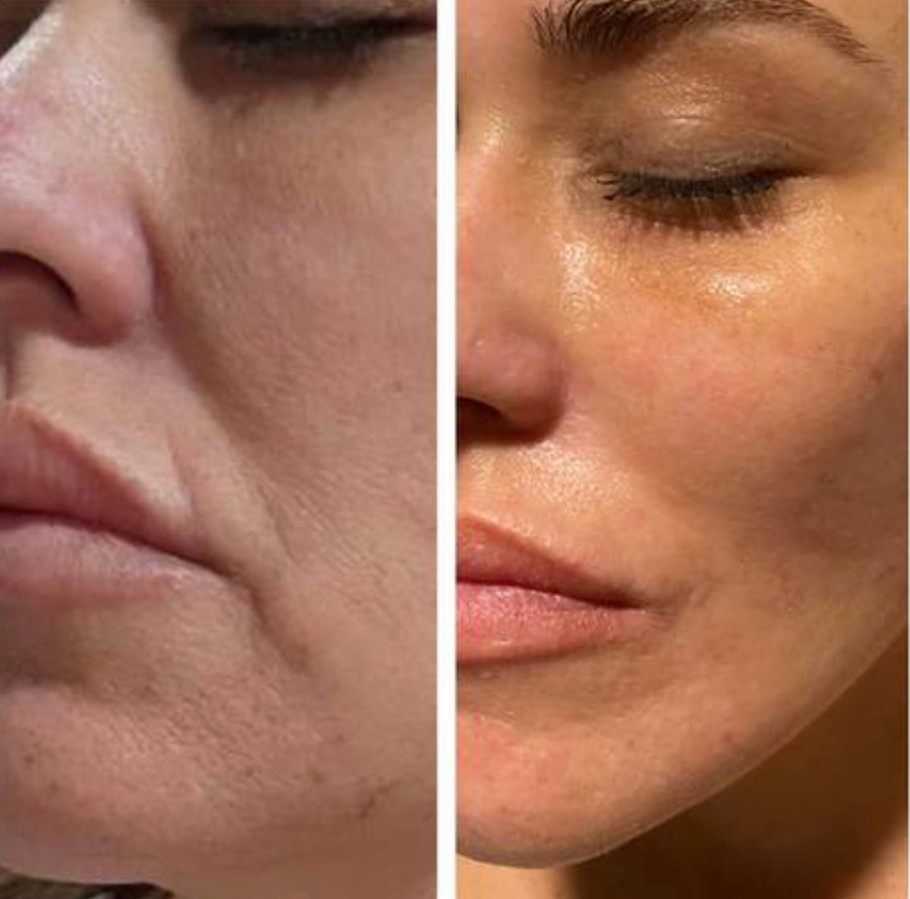 Radiesse® Biostimulator Filler