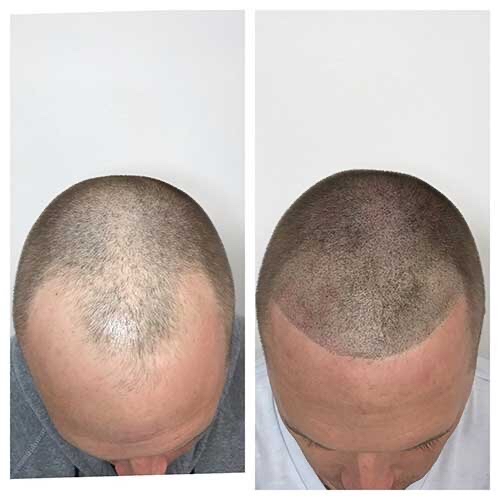 Scalp micro pigmentation at Permanent Cosmetics By Alicia Polk in Bentonville, AR