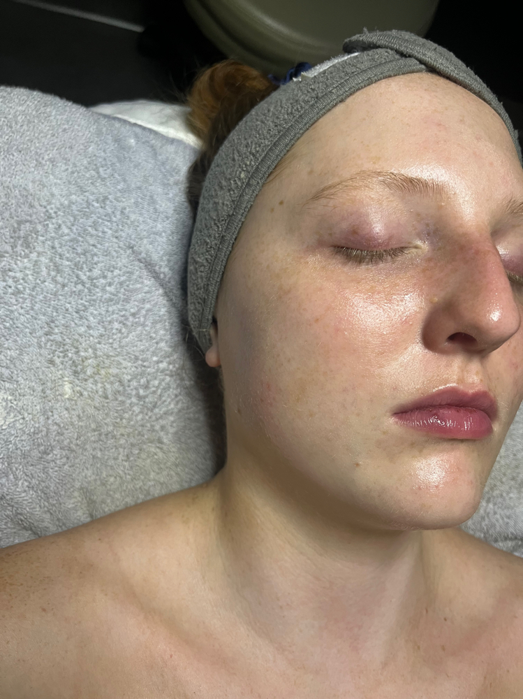 Teen Facial