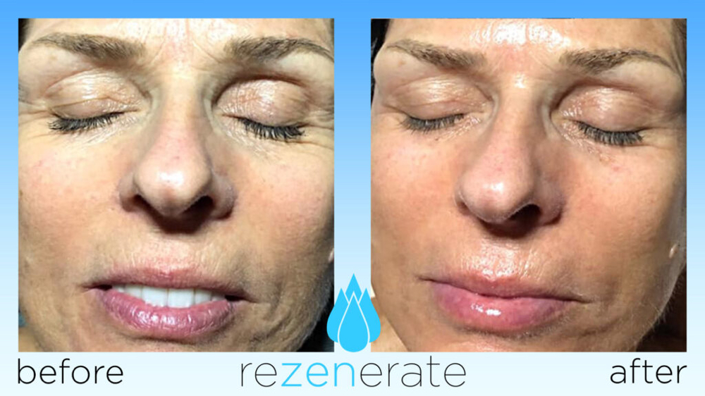 Rezenerate Nanofacial