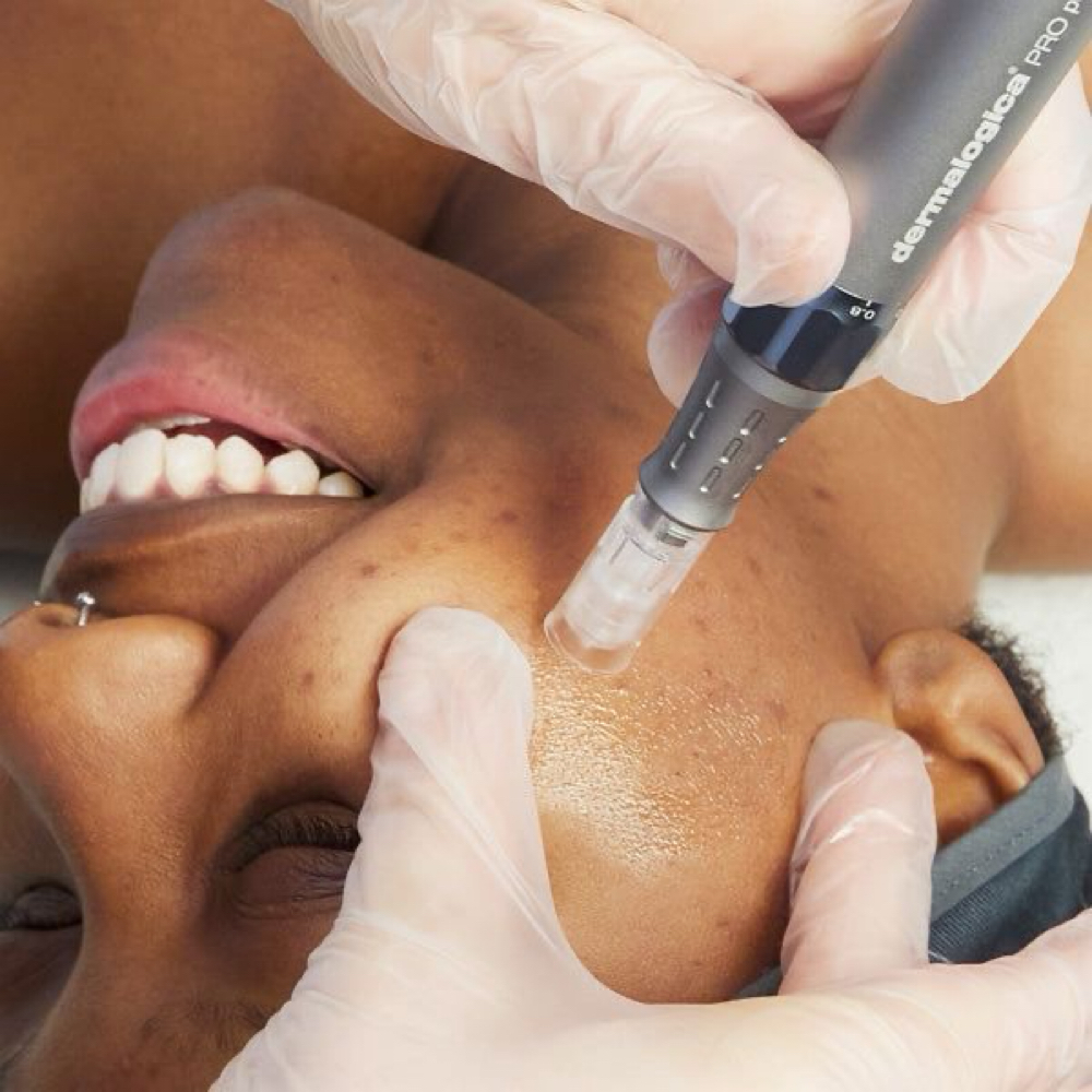 Microneedling + Essential serum at vallusa skincare & brows in miami, FL