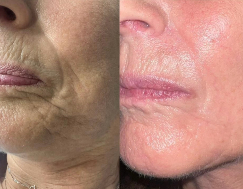 Fine Lines & Wrinkles (Inkless)
