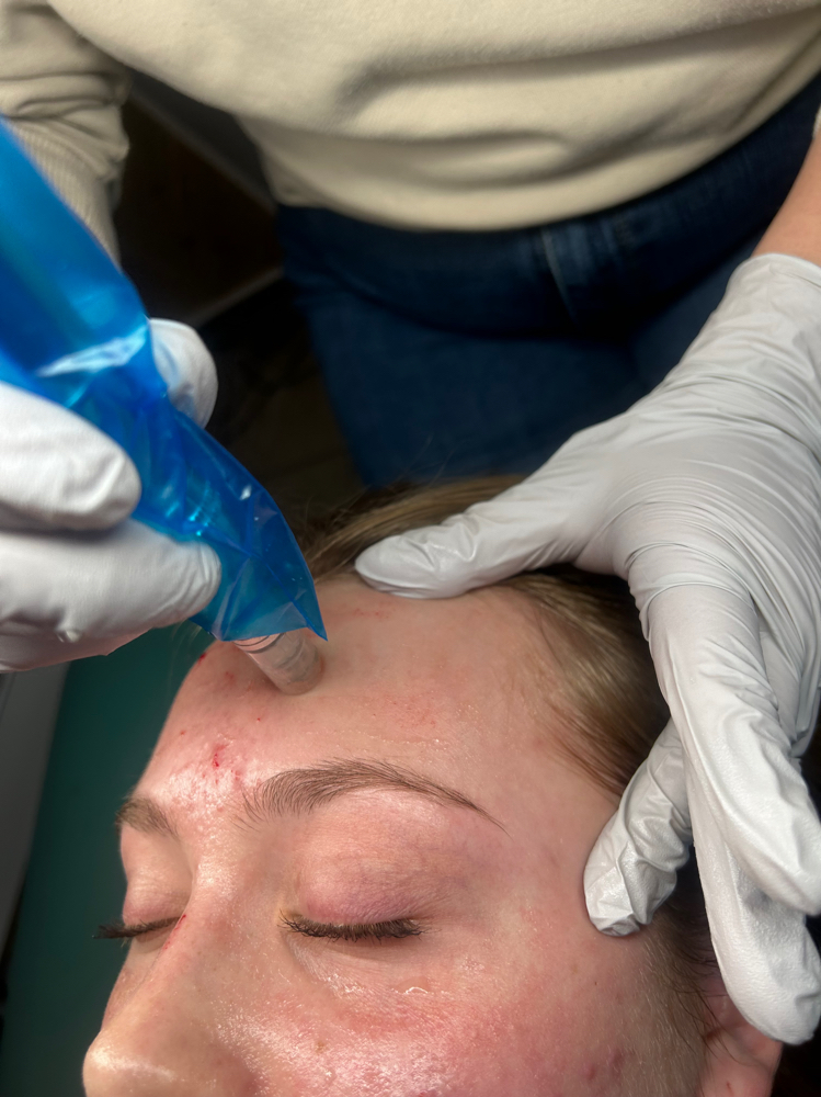 Microneedling With PRP at Lace Esthetics in Chino Valley, AZ