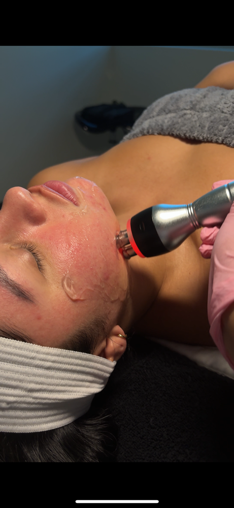 RF Facial