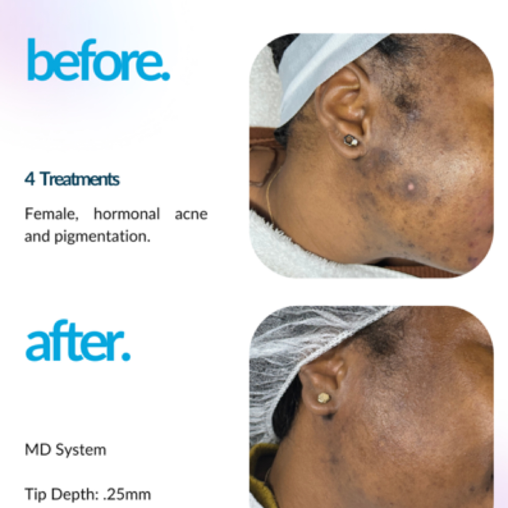 Full Face Package (6 sessions) at Altar Beauty Co. by Yury in Payette, ID