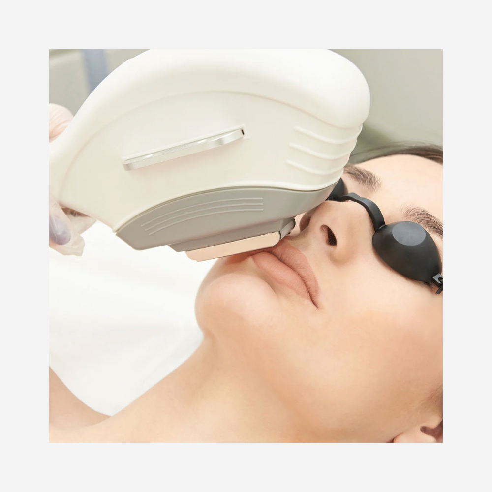 IPL Photofacial laser