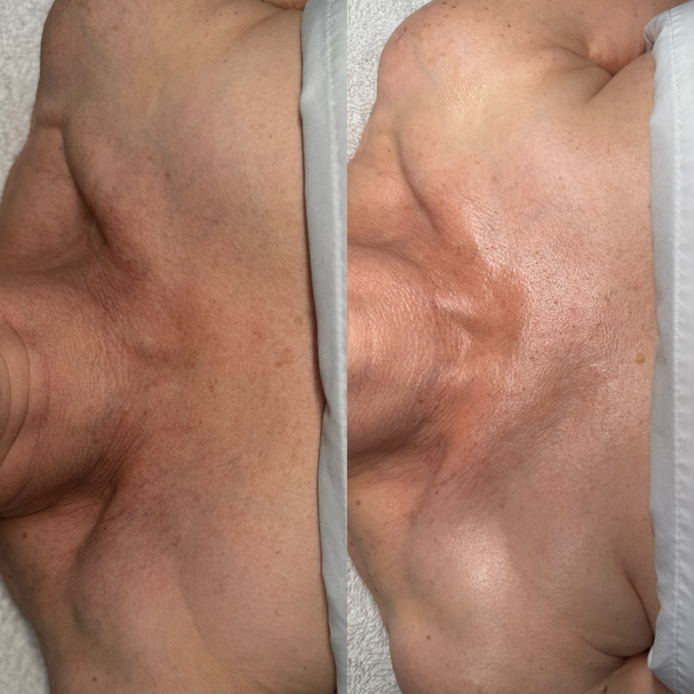 Décolleté Perfecting Treatment ✨