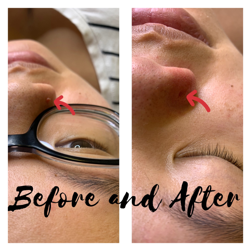 Skin Tag Removal 1 Hr