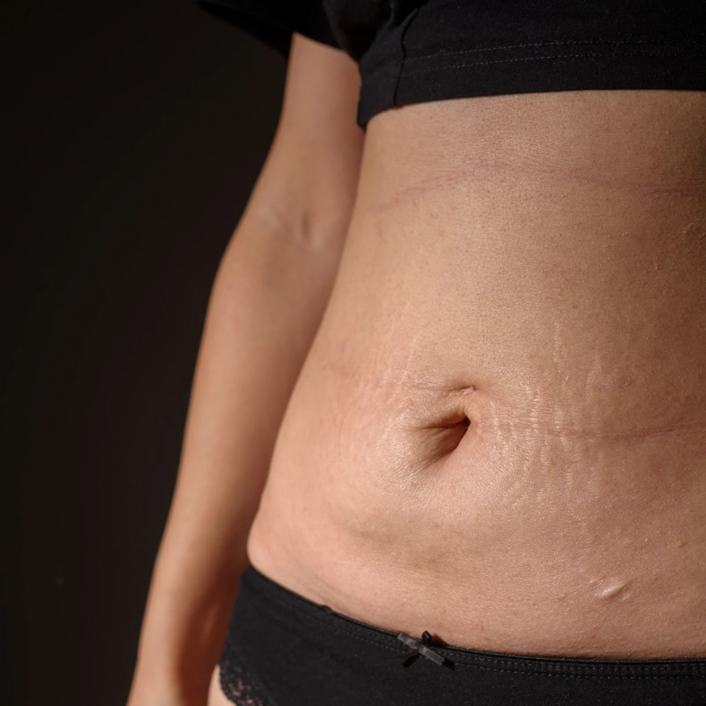 Stretch Mark & Scar Treatments