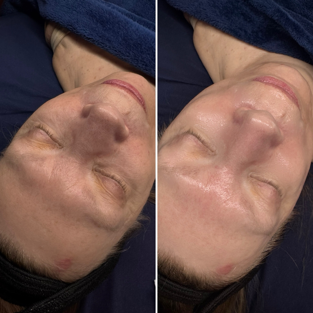Botox Facial