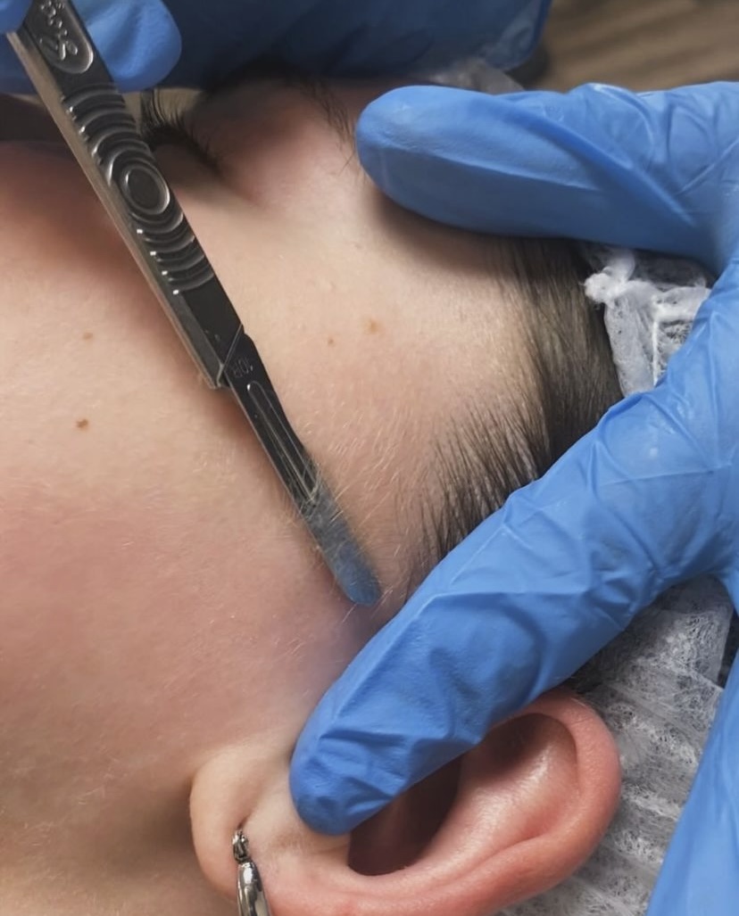 Dermaplaning