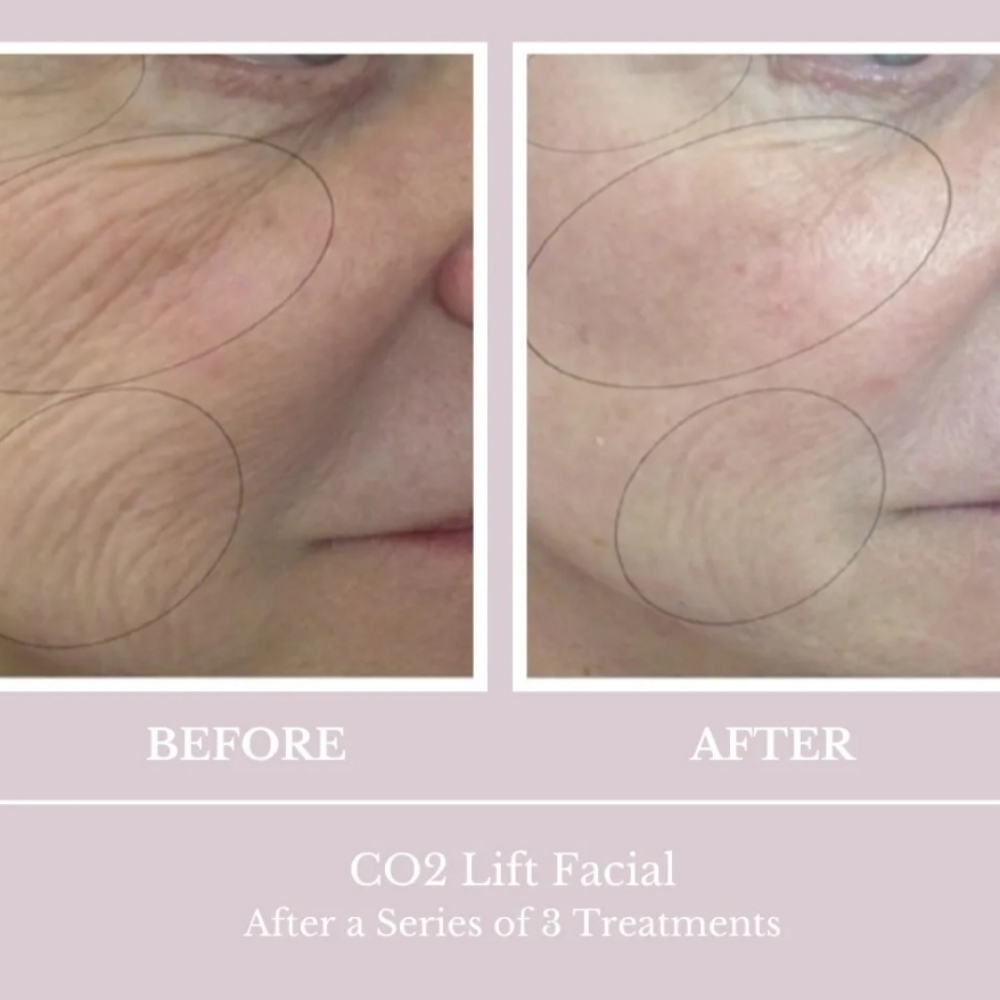 Carboxytherapy Treatments at Glass Face Aesthetics LLC in Fort Stockton, TX
