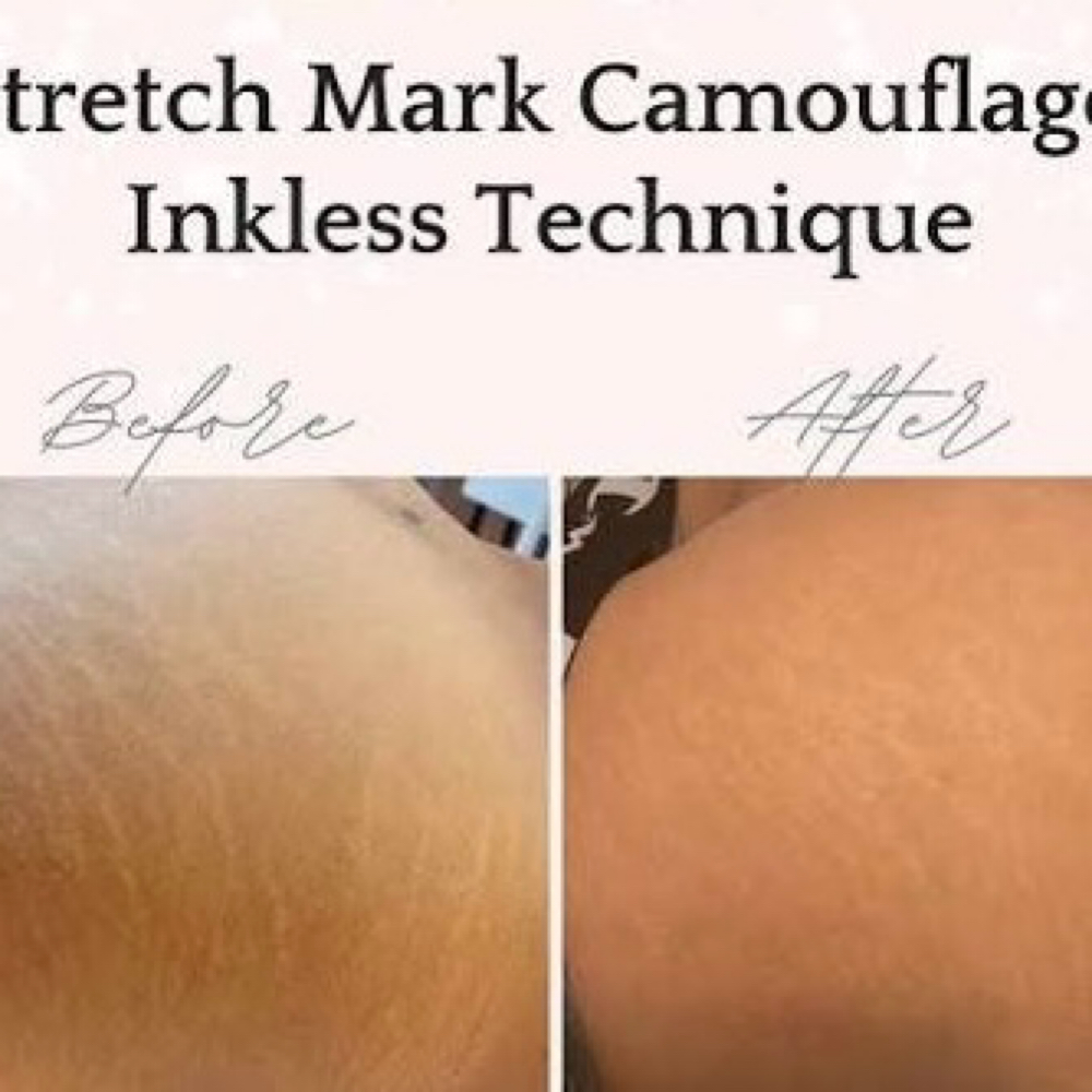 Inkless Stretch Mark Revision at Marie Goodwin in Lakewood, OH