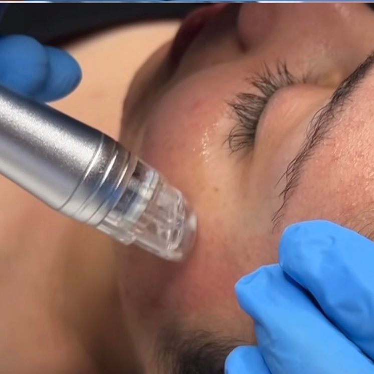 HydroDermabrasion Facial at Esthetics x Evelyn in Bakersfield, CA