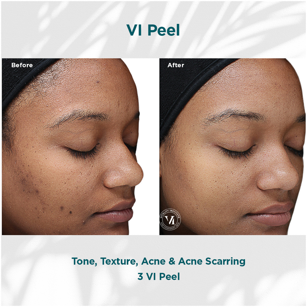 Virtual VI Peel Consult at Trilogy Aesthetics Medspa & Wellness in Atlanta, GA